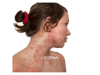 the best facial remedies for treating eczema.